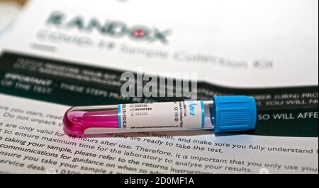 The Coronavirus home collection test kit contains a nasal and throat swab which collect a sample of cells which is sent back to a lab for testing. The lab performs a very sensitive test that looks for the RNA of the virus using a technique called RT-PCR. RT-PCR tests work by detecting specific genetic material known as viral RNA within the virus. By detecting viral RNA, which will be present in the body before symptoms of the disease are present, the tests can tell whether or not someone has the virus very early on. Stock Photo