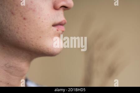 Close-up portrait on the skin of a young Caucasian boy in pubertal age: on his skin there are several recognizable pimples at different times of their Stock Photo