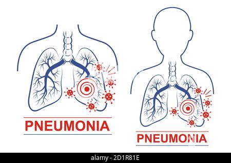 Pneumonia disease vector icon set. Human lungs and trachea anatomy. Treating for pneumonia. Treatment for coronavirus attack of respiratory system Stock Vector
