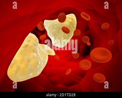 Cholesterol plaque in artery (atherosclerosis) and erythrocytes. Clogged Artery. 3d render Stock Photo