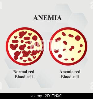 Anemia amount of red blood Iron deficiency anemia difference of Anemia ...