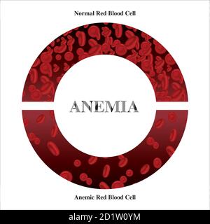 Anemia amount of red blood Iron deficiency anemia difference of Anemia amount of red blood cell and normal symptoms vector illustration medical. Stock Vector