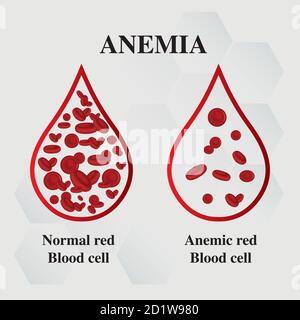 Anemia amount of red blood Iron deficiency anemia difference of Anemia ...