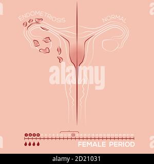 Illustration of endometriosis, endometrial tissue in the uterus, female disease, womens medicine Stock Vector