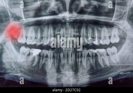 Panoramic x-ray scanning of human teeth. Female teeth with one wisdom tooth highlighted in red Stock Photo