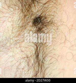 Brown Spot On The Skin Pigmented Spots And Moles Mole And Skin Hair Stock Photo Alamy