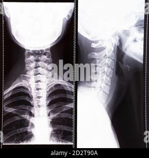 X ray MRI image of human spinal column neck and skull for medical diagnostic concept Stock Photo