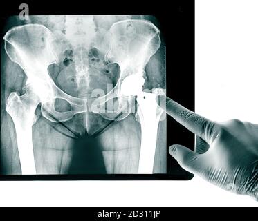 X-ray of the pelvis Endoprosthesis, the socket of the hip joint used for Hip Joint  rheumatic diseases and Rheumatoid Arthritis Stock Photo