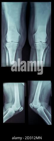 X-ray rheumatic diseases and knee Rheumatoid Arthritis two legs Stock Photo