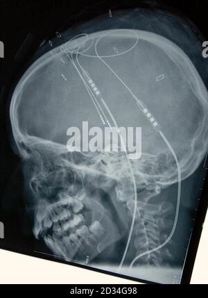 X-ray of ten year old Amber Sissons' skull showing the electrodes implanted in her brain. Amber is in St Thomas' Hospital, London recovering from the brain operation. Amber suffers from a rare genetic disorder that causes contortions and involuntary movements. The condition, known as PANK 2, or Hallervorden-Spatz disease, is progressive and crippling. Doctors have given the 10-year-old girl back her smile after a life-changing brain operation just in time for Christmas. Three days after the operation, Amber has undergone a transformation which astonished the medical team caring for her at St T Stock Photo