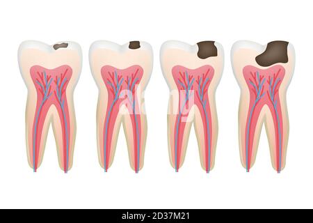 Caries tooth. Decay pulpit dental problem procedure root vector tooth medical pictures Stock Vector