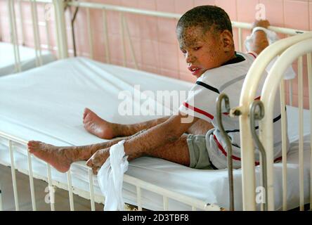 A Young Vietnamese With A Skin Disorder And Metal Retardation Sits In His Cot At The Peace Village In Tu Du Hospital In Ho Chi Minh City February 3 04 The Boy