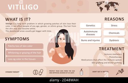 Infographics of vitiligo. Causes of the disease. Abstract woman silhouette. Vector concept to support people living with vitiligo and to build Stock Vector