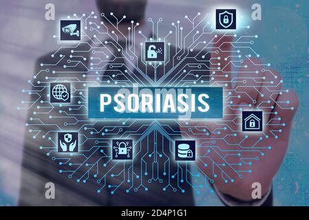 Writing note showing Psoriasis. Business concept for chronic skin disease characterized by patches with white scales System administrator control, gea Stock Photo