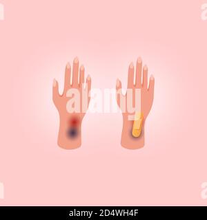 Physical injury human hand with open cut. Medical adhesive plaster on pink background. Flat lay style. Stock Vector