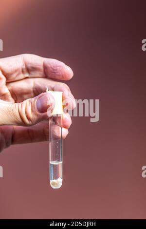 Basal cell carcinoma in skin sampling of the skin covering the back for histopathological examination immersed in formalin in a test tube Stock Photo