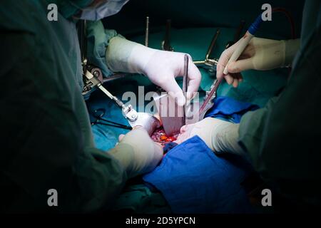 Surgeons transplanting a liver Stock Photo