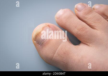 Onychomycosis, The Initial Stage Of Mycosis. Big Toe Infected With ...