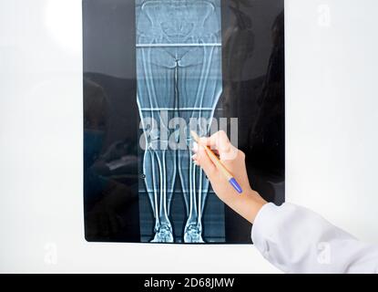 X-ray of knee joint on a negatoscope, X-ray as a type of diagnosis for the treatment of diseases and injuries of the joints of the legs Stock Photo