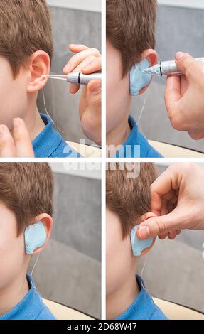 Set of making a custom earplug for a boy. Stages of manufacturing earplugs. doctor makes custom molded ear plugs for the patient. Ear close-up Stock Photo