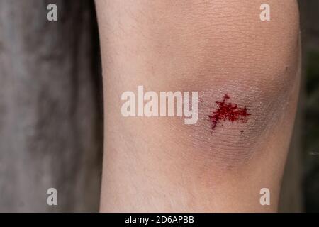 The knee is scratched. Close up on an bleeding scraped child his knee after run accident. Stock Photo
