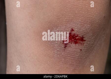 The knee is scratched. Close up on an bleeding scraped child his knee after run accident. Stock Photo