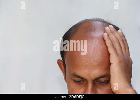 Half bald head asian man upset over further hair loss problem isolated on copy space white background Stock Photo