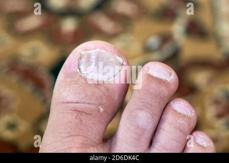 Leg Finger Nail Infection Problem Nails Stock Photo 2252207959 |  Shutterstock