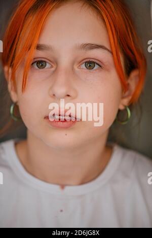 little girl with a broken lip. Girl with a broken lip Stock Photo