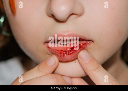 little girl with a broken lip. Girl with a broken lip Stock Photo