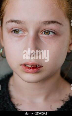 little girl with a broken lip. Girl with a broken lip Stock Photo