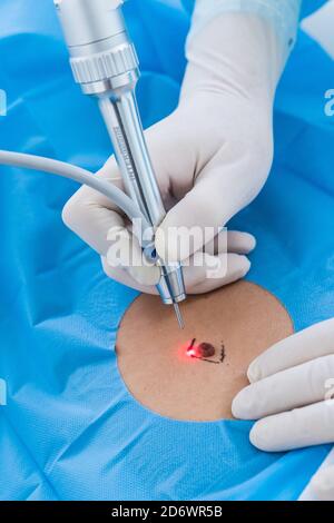 Exeresis of a nevus (mole) using a CO2 surgical laser, Center Cosem Paris. Stock Photo