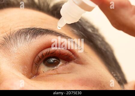 Hand placing drops of eye drops in inflamed eye with infected stye, upper eyelid, ophthalmic medicine. Stock Photo