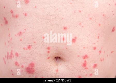 Close-up of skin disorder as hives or allergy. Human body with rash Stock Photo