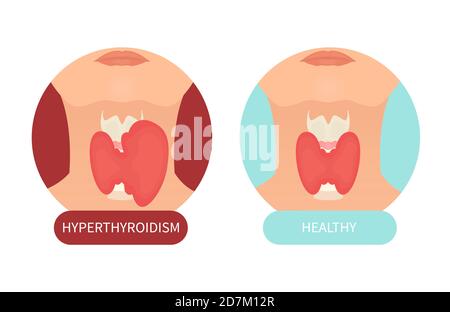 Hyperthyreosis Hyperthyroidism and healthy thyroid gland, illustration Stock Photo - Alamy