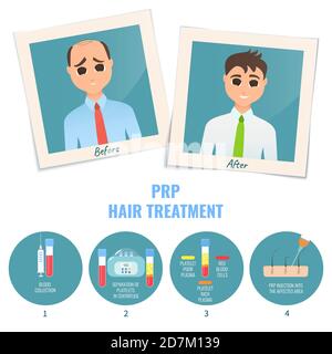 Man before and after PRP (platelet rich plasma) treatment for male hair loss, illustration. Stock Photo