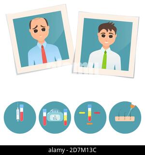 Man before and after PRP (platelet rich plasma) treatment for male hair loss, illustration. Stock Photo
