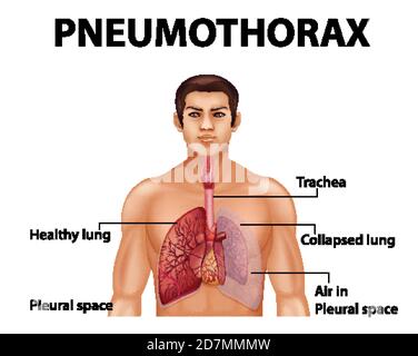 Informative illustration of Pneumothorax illustration Stock Vector