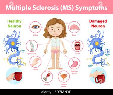 Multiple sclerosis (MS) symptoms information infographic Stock Vector ...