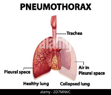 Informative illustration of Pneumothorax illustration Stock Vector