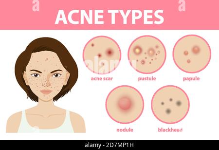 Types of acne on the skin or pimples illustration Stock Vector