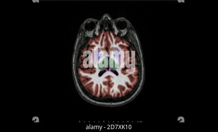 Magnetic resonance imaging of the brain in axial plane color coded sequence used for diagnosis of memory impairment and Alzheimer disease. MRI brain. Stock Photo