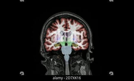 Magnetic resonance imaging of the brain in coronal plane color coded sequence used for diagnosis of memory impairment and Alzheimer disease. MRI brain Stock Photo