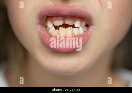 close-up on the lower part of the child's face, 7 year old toddler girl or boy shows milk teeth and growing permanent. Soft selective focus. Macro. Ch Stock Photo