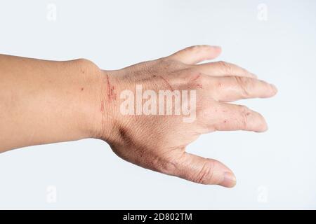 The back of the injured hand is isolated in a white background Stock Photo