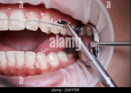 Close up view on dentist taking off black rubber bands from ceramic braces with a help of dental hook to replace rusty wire which connects the braces. Concept of orthodontics treatment and dentistry Stock Photo
