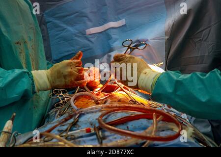 Beating human heart in opened chest during the surgery chest during heart surgery Stock Photo