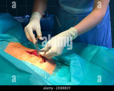 a surgeon sews up a large wound on the abdomen with a needle holder and thread Stock Photo