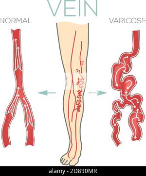 Varicose veins, large, swollen vein on the legs and feet. Valves do not work, blood does not flow effectively. Medical schematic vector illustration. Stock Vector