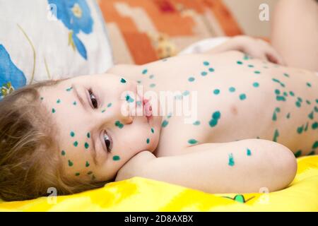 Portrait of cute little girl with sad eyes, kid lying on bed with chickenpox. Spots with green medicinal preparations on a body. Varicella virus or Ch Stock Photo